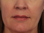 Lip Augmentation Before and after photo