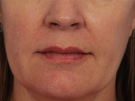 Lip Augmentation before and after photo