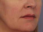 Lip Augmentation Before and after photo