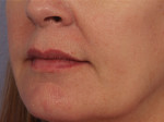 Lip Augmentation Before and after photo