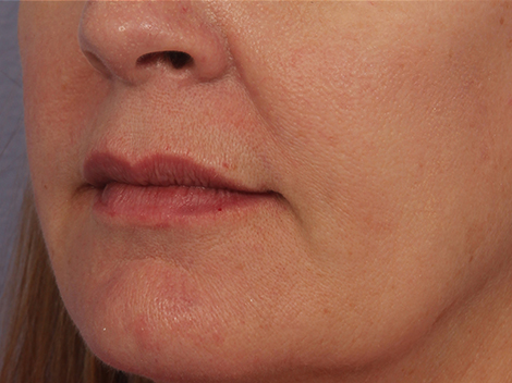 Lip Augmentation before and after photo