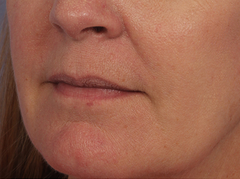 Lip Augmentation before and after photo