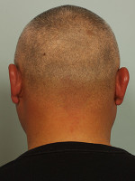 Hair Restoration by NeoGraft® Before and after photo