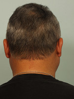 Hair Restoration by NeoGraft® Before and after photo