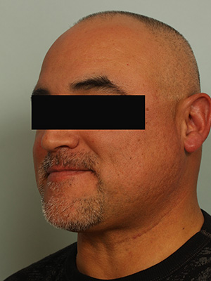 Hair Restoration by NeoGraft® before and after photo