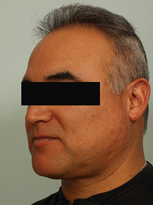 Hair Restoration by NeoGraft® before and after photo