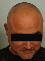 Hair Restoration by NeoGraft® Before and after photo