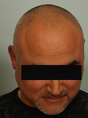 Hair Restoration by NeoGraft® before and after photo