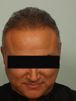 Hair Restoration by NeoGraft® Before and after photo