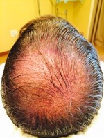 Hair Restoration by NeoGraft® Before and after photo