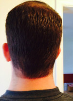 Hair Restoration by NeoGraft® Before and after photo