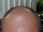 Hair Restoration by NeoGraft® Before and after photo