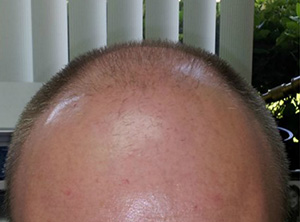 Hair Restoration by NeoGraft® before and after photo