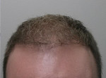 Hair Restoration by NeoGraft®