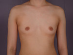 Breast Augmentation Before and after photo