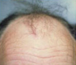 Hair Restoration by NeoGraft® Before and after photo