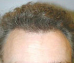 Hair Restoration by NeoGraft®