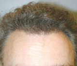 Hair Restoration by NeoGraft® before and after photo