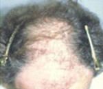 Hair Restoration by NeoGraft® Before and after photo