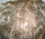 Hair Restoration by NeoGraft® Before and after photo