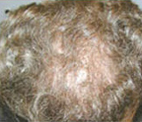 Hair Restoration by NeoGraft® before and after photo