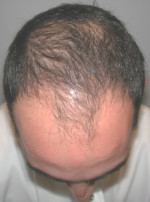 Hair Restoration by NeoGraft® Before and after photo