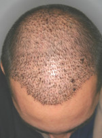 Hair Restoration by NeoGraft® Before and after photo