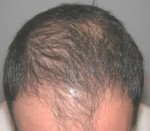 Hair Restoration by NeoGraft® Before and after photo