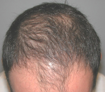 Hair Restoration by NeoGraft® before and after photo