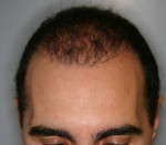 Hair Restoration by NeoGraft® Before and after photo