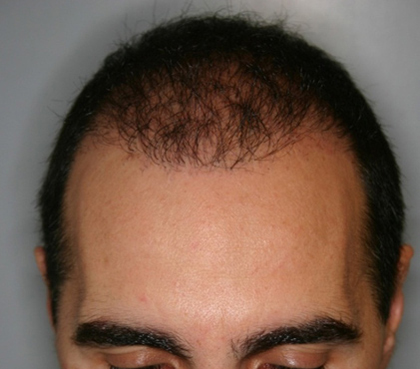 Hair Restoration by NeoGraft® before and after photo