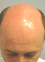 Hair Restoration by NeoGraft®