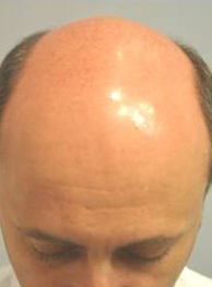 Hair Restoration by NeoGraft® before and after photo