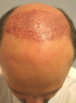 Hair Restoration by NeoGraft® Before and after photo