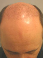 Hair Restoration by NeoGraft® Before and after photo