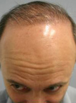 Hair Restoration by NeoGraft®