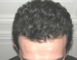 Hair Restoration by NeoGraft®