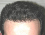 Hair Restoration by NeoGraft®