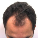 Hair Restoration by NeoGraft® Before and after photo