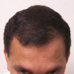 Hair Restoration by NeoGraft® Before and after photo