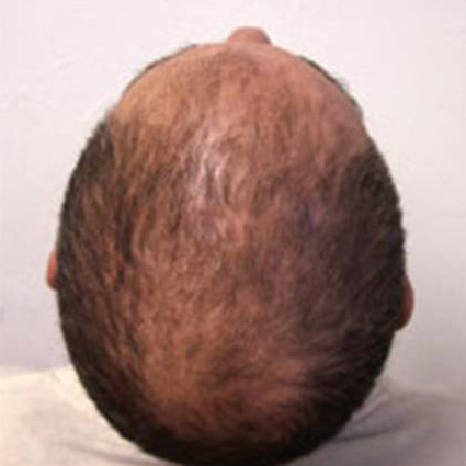 Hair Restoration by NeoGraft® before and after photo