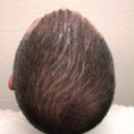 Hair Restoration by NeoGraft®