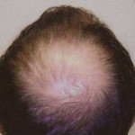 Hair Restoration by NeoGraft® Before and after photo