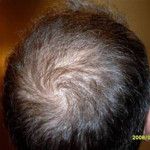 Hair Restoration by NeoGraft® Before and after photo