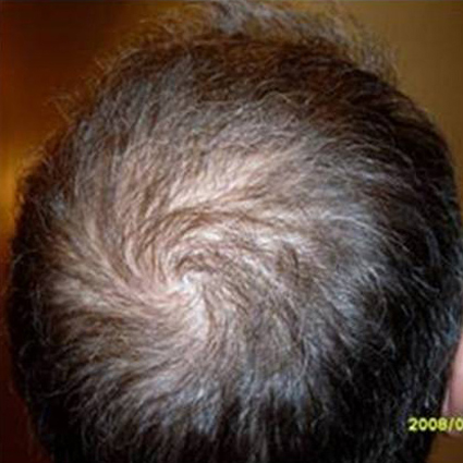 Hair Restoration by NeoGraft® before and after photo