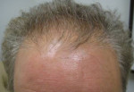 Hair Restoration by NeoGraft®