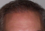 Hair Restoration by NeoGraft® Before and after photo