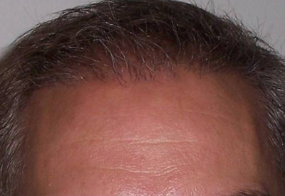 Hair Restoration by NeoGraft® before and after photo