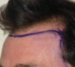 Hair Restoration by NeoGraft® Before and after photo