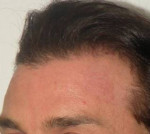 Hair Restoration by NeoGraft® Before and after photo